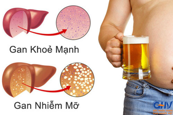 Những người uống nhiều rượu, bia thì tác hại xảy ra với gan bắt đầu là gan nhiễm mỡ, dẫn đến viêm gan, xơ gan.
