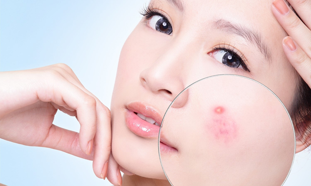 Nguyên nhân gây ra mụn và cách điều trị